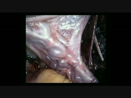 Histerektomia laparoskopowa z lymphadeniectomią w raku trzonu macicy