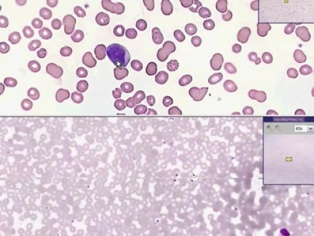 Ostra białaczka - histopatologia - krew