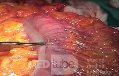 Obraz endoskopowy gruczolakoraka okrężnicy poprzecznej (5 z 9)