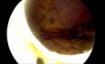 Hernie diaphragmatique post traumatique gauche - le traitement laparoscopique