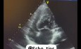 Wrodzone przełożenie wielkich pni tętniczych (TGA)