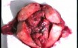 Całkowite wycięcie macicy z powodu raka endometrium
