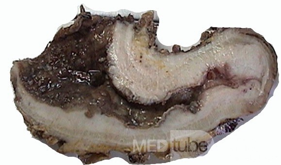 Żołądek w kształcie skórzastej butelki z obustronnym guzem Krukenberga (10 z 13)