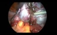 Zabieg laparoskopowy endometriozy IV stopnia