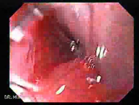 Gruczolakorak przełyku w okolicy połączenia żołądkowo-przełykowego - obraz endoskopowy