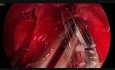 Lobektomia dolna lewa wykonana metodą Uniportal VATS bez intubacji