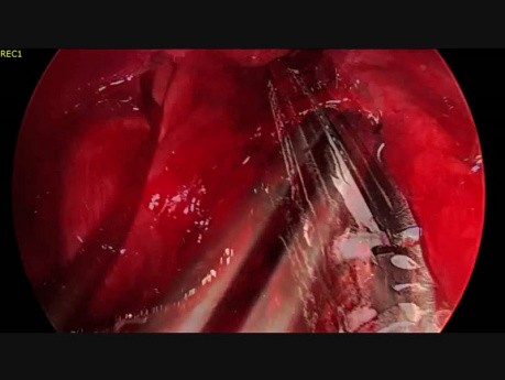 Lobektomia dolna lewa wykonana metodą Uniportal VATS bez intubacji