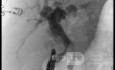Endoskopowa choledochoduodenostomia pod kontrolą EUS [6/7]
