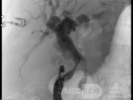 Endoskopowa choledochoduodenostomia pod kontrolą EUS [6/7]