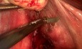 Laparoskopowe usunięcie mięśniaka z lewych przymacicz