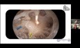 Anatomia okienka owalnego i implant ślimakowy metodą endoskopową