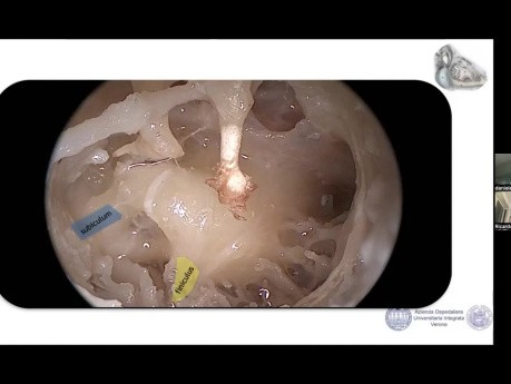 Anatomia okienka owalnego i implant ślimakowy metodą endoskopową