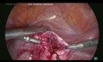 Laparoskopowa operacja gruczolakomięśniaka torbielowatego. 