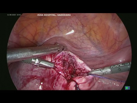 Laparoskopowa operacja gruczolakomięśniaka torbielowatego. 