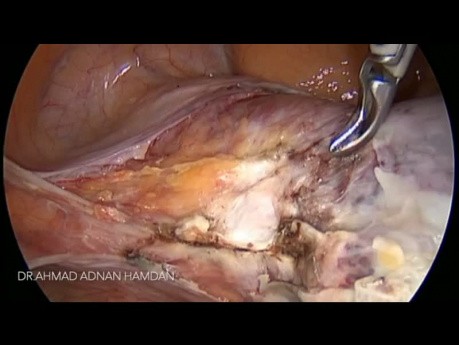Całkowite laparoskopowe wycięcie macicy