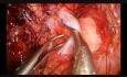Śródosierdziowa bilobektomia (intrapericardial bilobectomy) z częściową resekcją żyły głównej górnej metodą VATS z użyciem jednego portu