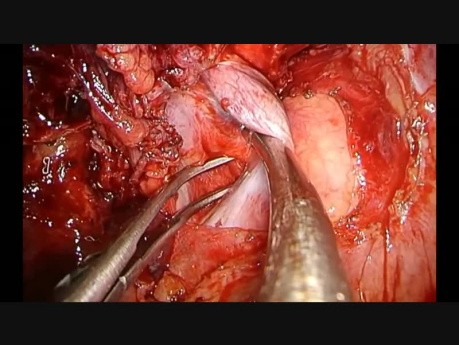 Śródosierdziowa bilobektomia (intrapericardial bilobectomy) z częściową resekcją żyły głównej górnej metodą VATS z użyciem jednego portu