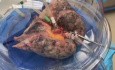 New Usages of EVLPD Technology in Lung Donation and Transplant 