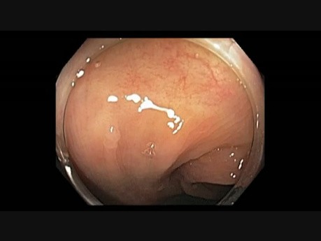 Niewielki polip okrężnicy - wykorzystanie nakładki