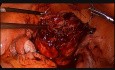 Zabieg laparoskopowej miomektomii w przypadku masywnych  mięśniaków śródściennych