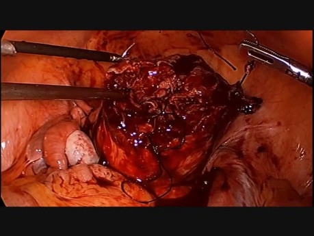 Zabieg laparoskopowej miomektomii w przypadku masywnych  mięśniaków śródściennych
