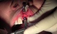 Wszczepienie implantu - #9 - przygotowanie łoża i umieszczenie implantu