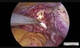 Jednoczesna histerektomia i cholecystektomia laparoskopowa