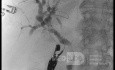 Endoskopowa choledochoduodenostomia pod kontrolą EUS [2/7]