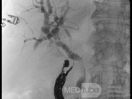 Endoskopowa choledochoduodenostomia pod kontrolą EUS [2/7]