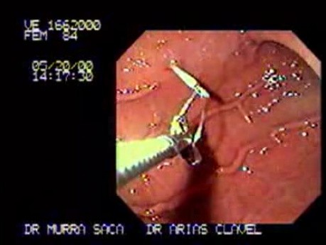 Przezskórna endoskopowa gastrostomia (2 z 3)