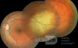 Przerzut raka płuc  do gałki ocznej