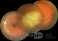 Przerzut raka płuc  do gałki ocznej