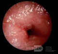 Ostre alergiczne kontaktowe zapalenie skóry przewodu słuchowego zewnętrznego