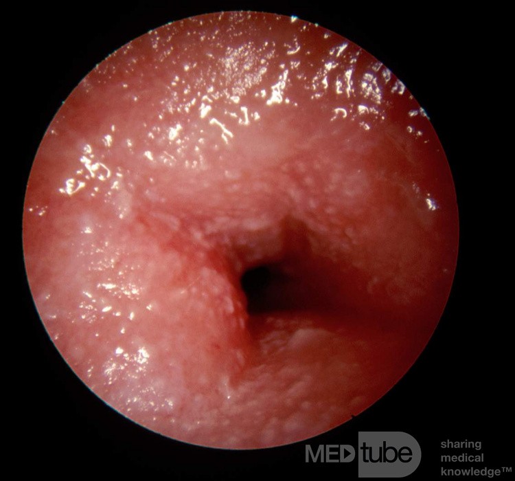 Ostre alergiczne kontaktowe zapalenie skóry przewodu słuchowego zewnętrznego