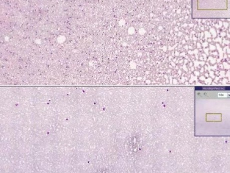 Przewlekła białaczka limfocytarna - histopatologia - krew