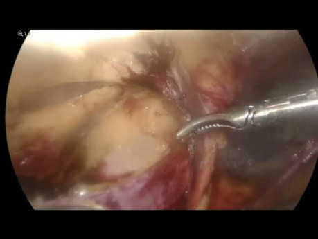 Operacja lewej przepukliny pachwinowej