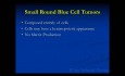 Kurs z ortopedii onkologicznej – nowotwory składające się z małych niebieskich okrągłych komórek (Mięsak Ewinga, Chłoniak) – wykład 8