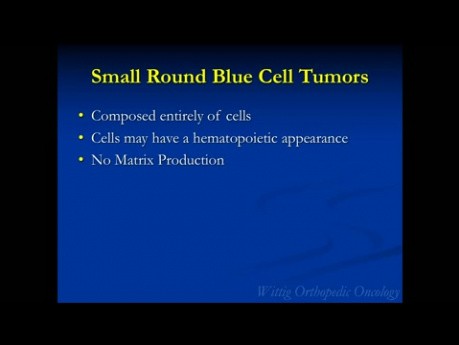 Kurs z ortopedii onkologicznej – nowotwory składające się z małych niebieskich okrągłych komórek (Mięsak Ewinga, Chłoniak) – wykład 8
