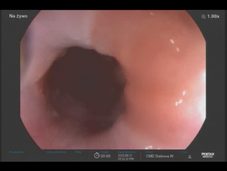 Endo Quiz, porozmawiajmy o jakości gastroskopii, czy gastroskopia, aby na pewno jest łatwiejsza od kolonoskopii, o jakości kolonoskopii wiemy już bardzo dużo u nas w Polsce