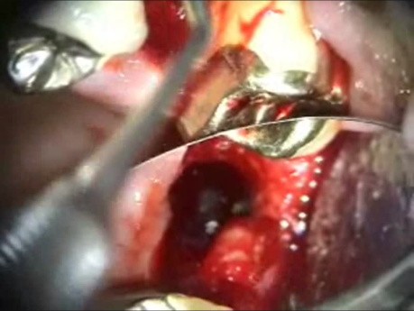 Mikrochirurgia implantologiczna: usunięcie i wymiana implantu