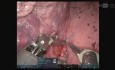 Resekcja anatomiczna segmentów S1-2 górnego płata lewego płuca metodą URATS