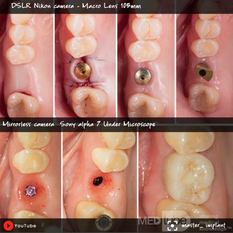 Implant stomatologiczny w odcinku tylnym 