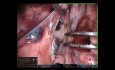 Segmentektomia anatomiczna S6 z użyciem robota