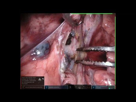 Segmentektomia anatomiczna S6 z użyciem robota