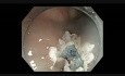 Kolonoskopia: endoskopowa resekcja śluzówkowa delikatnej zmiany w kątnicy
