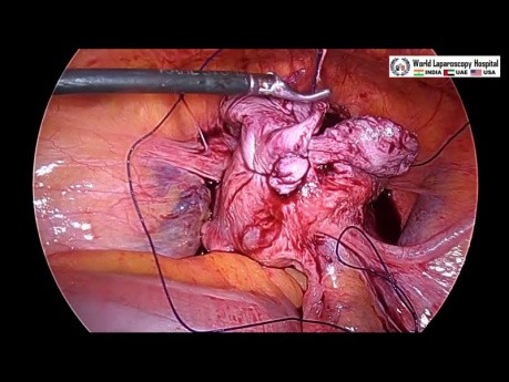 Laparoskopowa miomektomia przy macicy mięśniakowatej połączona z cholecystektomią z wykorzystaniem trzech portów