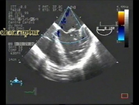 Infekcyjne zapalenie wsierdzia: przerwanie strun ścięgnistych obu płatków zastawki mitralnej z ciężką niedomykalnością - TEE