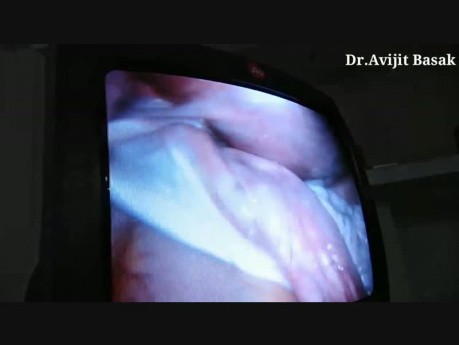 Masywna torbiel jajnika u pacjentki w ciąży- Dr.Avijit Basak