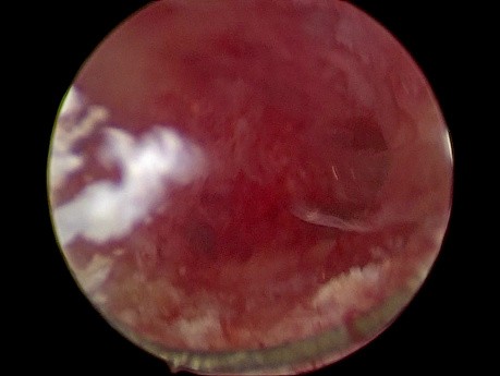 Hiperplazja endometrium. Czy w jamie macicy jest polip?
