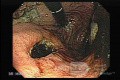 Rak żołądka - endoskopowa ocena śluzówki żołądka
